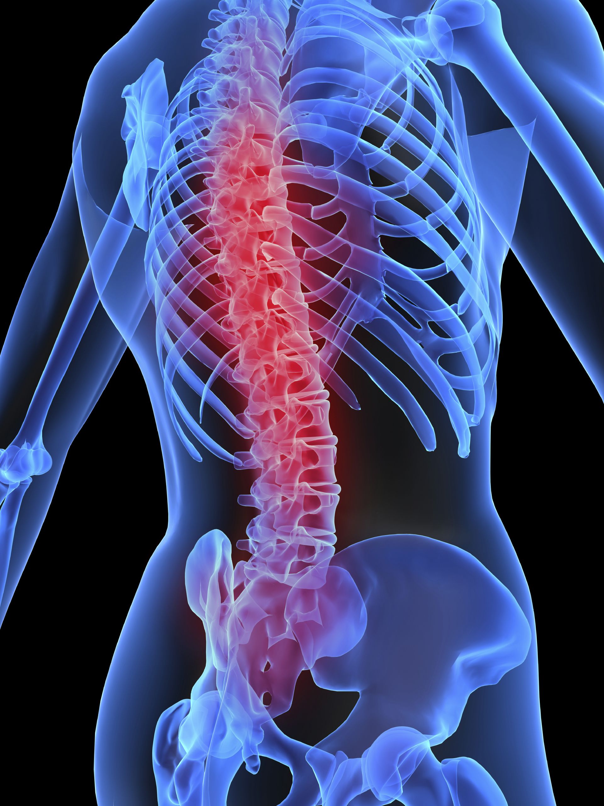 Spinal Injiry The Lifetime Costs of Spinal Injuries - Duque & Price